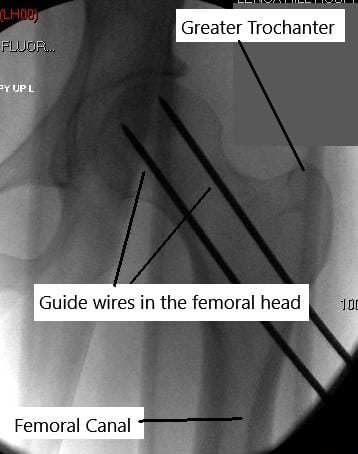 Guidewires passed to the femoral head.