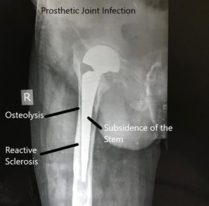 X-ray showing infected hip prosthetic joint.