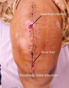 Prosthetic joint infection with redness of the overlying skin and swelling.