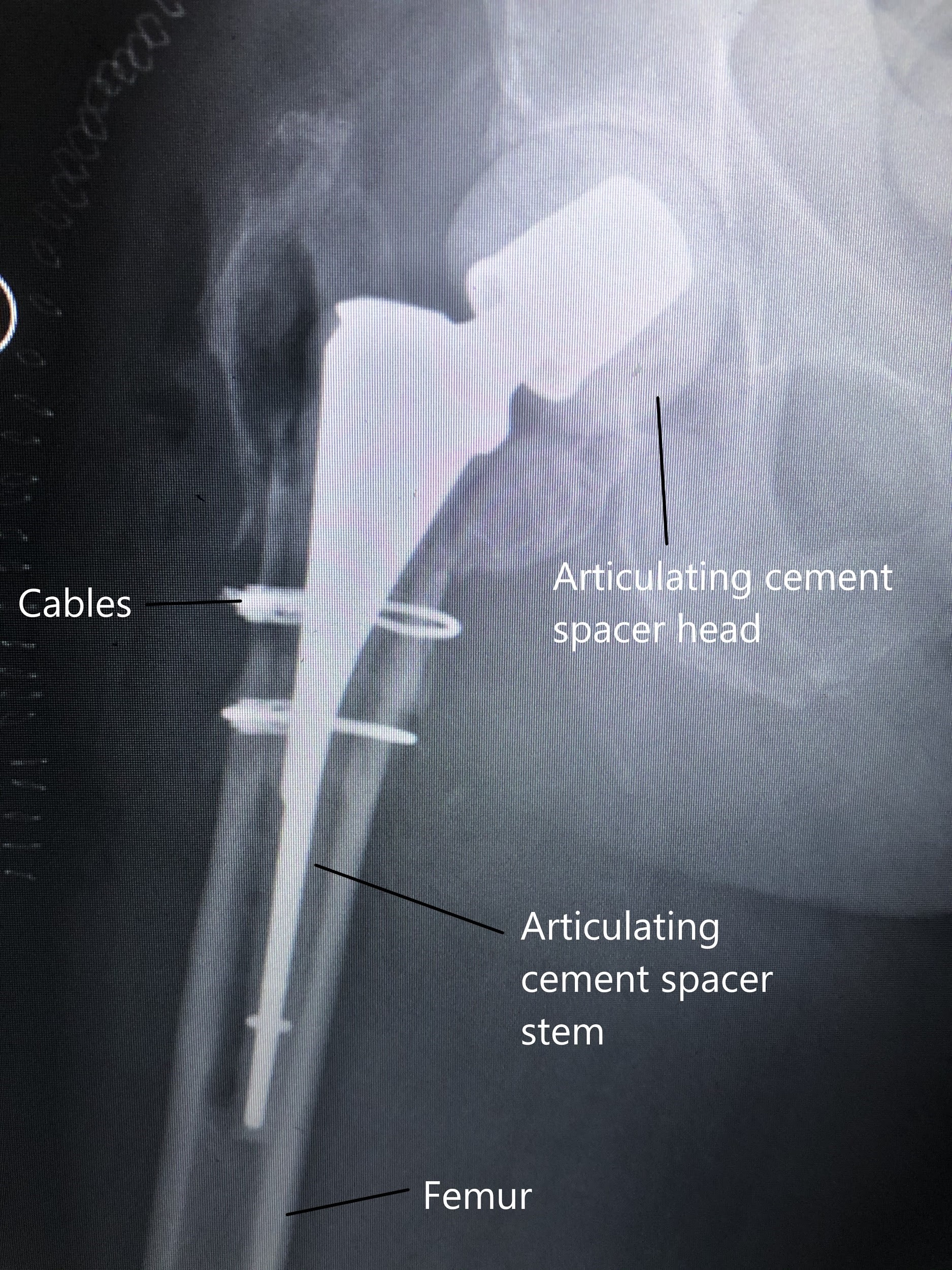 X-ray showing cement spacer in place