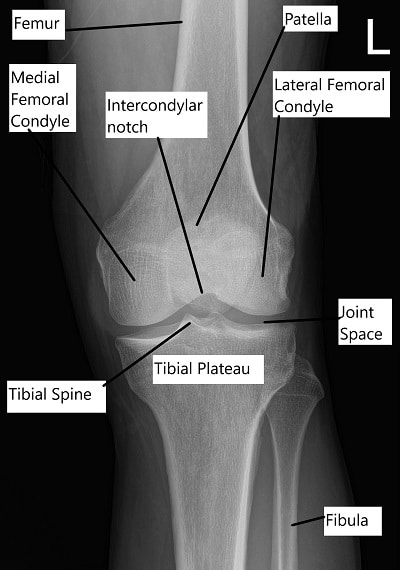 X-ray showing knee anatomy.
