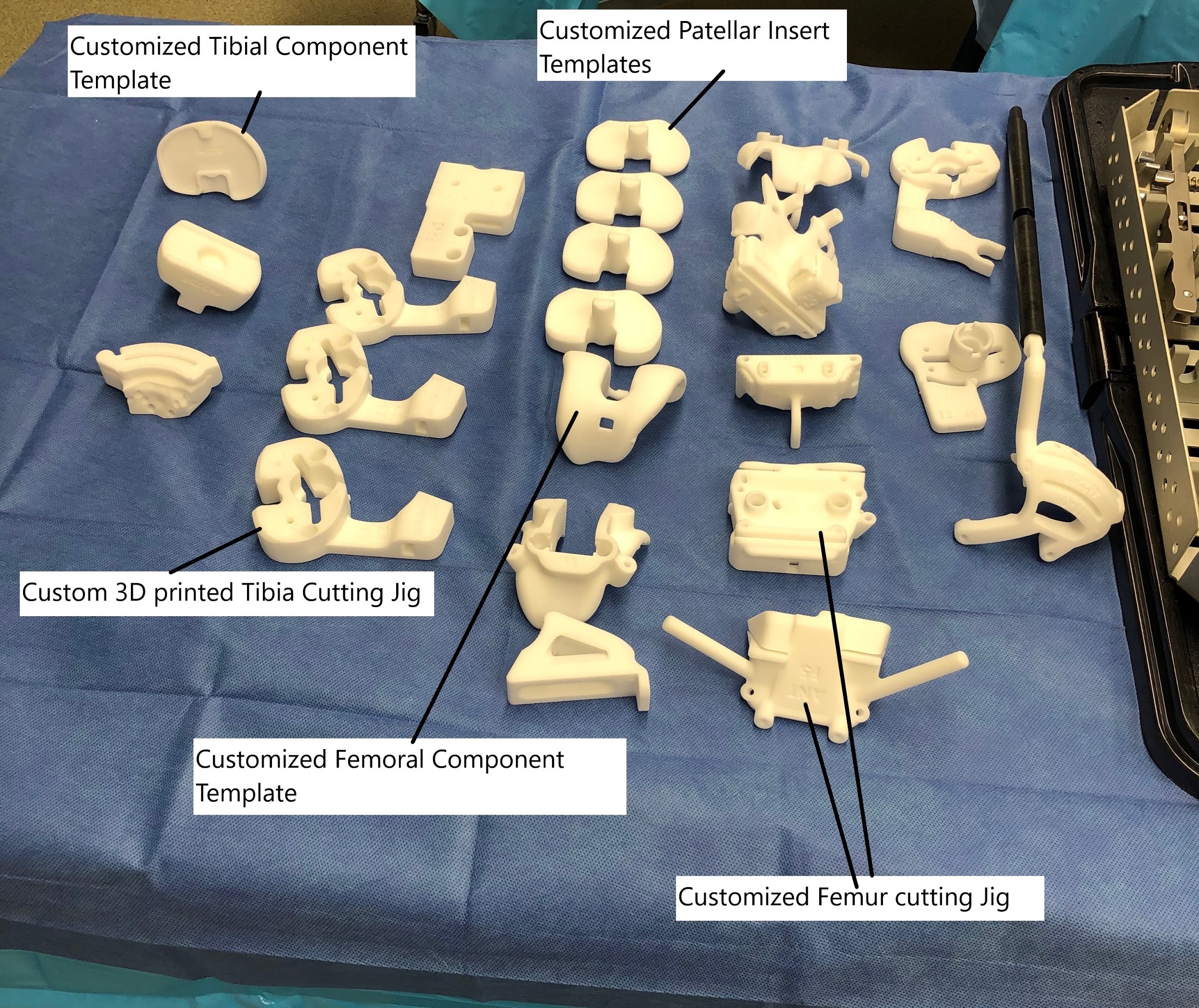Customized 3D printed instruments and templates for assisting knee arthroplasty