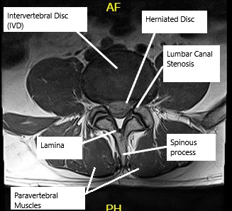 MRI showing Lumbar Canal Stenosis