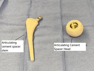 Revision Hip Replacement1