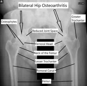 Osteoartritis de las articulaciones bilaterales de la cadera.