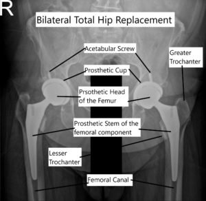 Bilateral total hip replacement 2