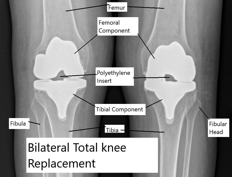 Total knee replacement of both knees.