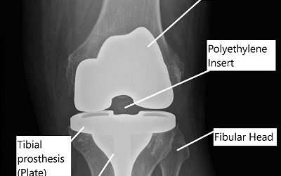 X-ray showing Total Knee Replacement.