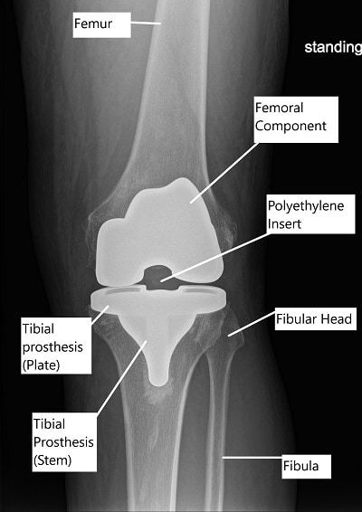 X-ray showing Total Knee Replacement.