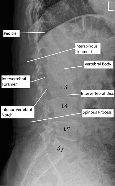 X-ray of the lumbar spine in the lateral view