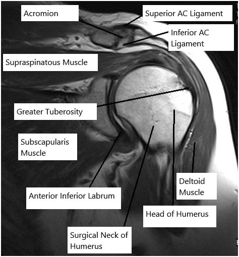 MRI of the shoulder joint