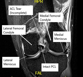 MRI of the knee showing partial ACL tear