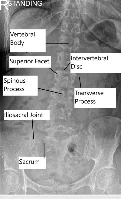 X-ray of the Lumbar Spine.
