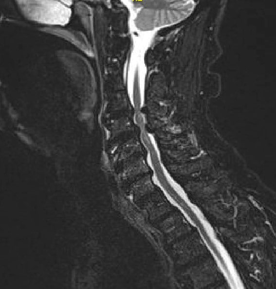 MRI T2 image Mid-Sagittal cut showing severe spinal cord stenosis and compression at C3-4 and C 5-6 with degenerative joint disease of Cervical spine