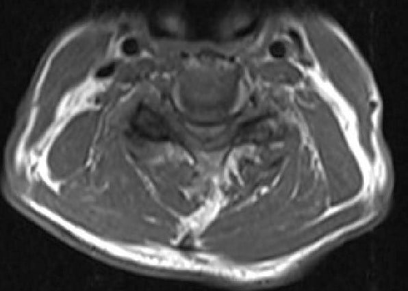 MRI T2 image Axial cut showing severe spinal cord stenosis and compression at C3-4