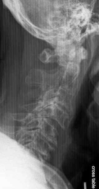 X rays Lateral view of C spine showing advanced degenerative Cervical spine disease