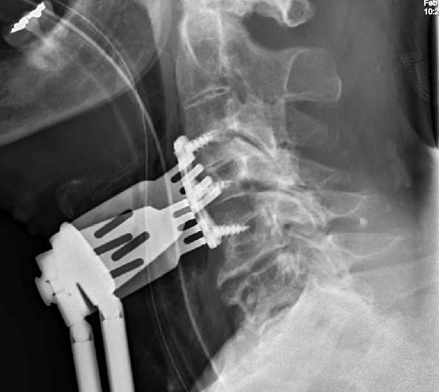Anterior Cervical Discectomy and Fusion was performed to relieve the pressure from the spinal cord with cleaning to disc and fusion using bone graft and plate and screws from the front