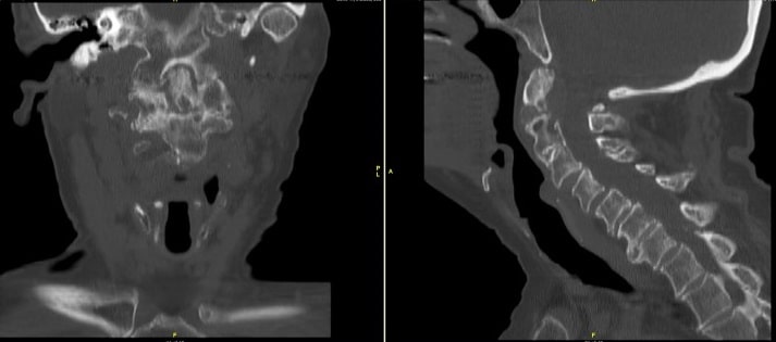 CT scan of Cervical Spine showing non-union of odontoid with along with degenerative changes of Cervical spine