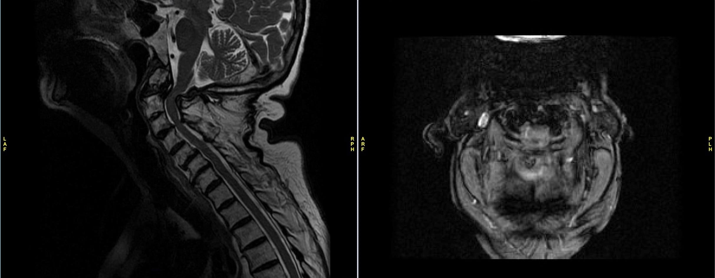 MRI of Cervical Spine showing critical stenosis at C1-2 with posterior fibrous pannus at odontoid fracture