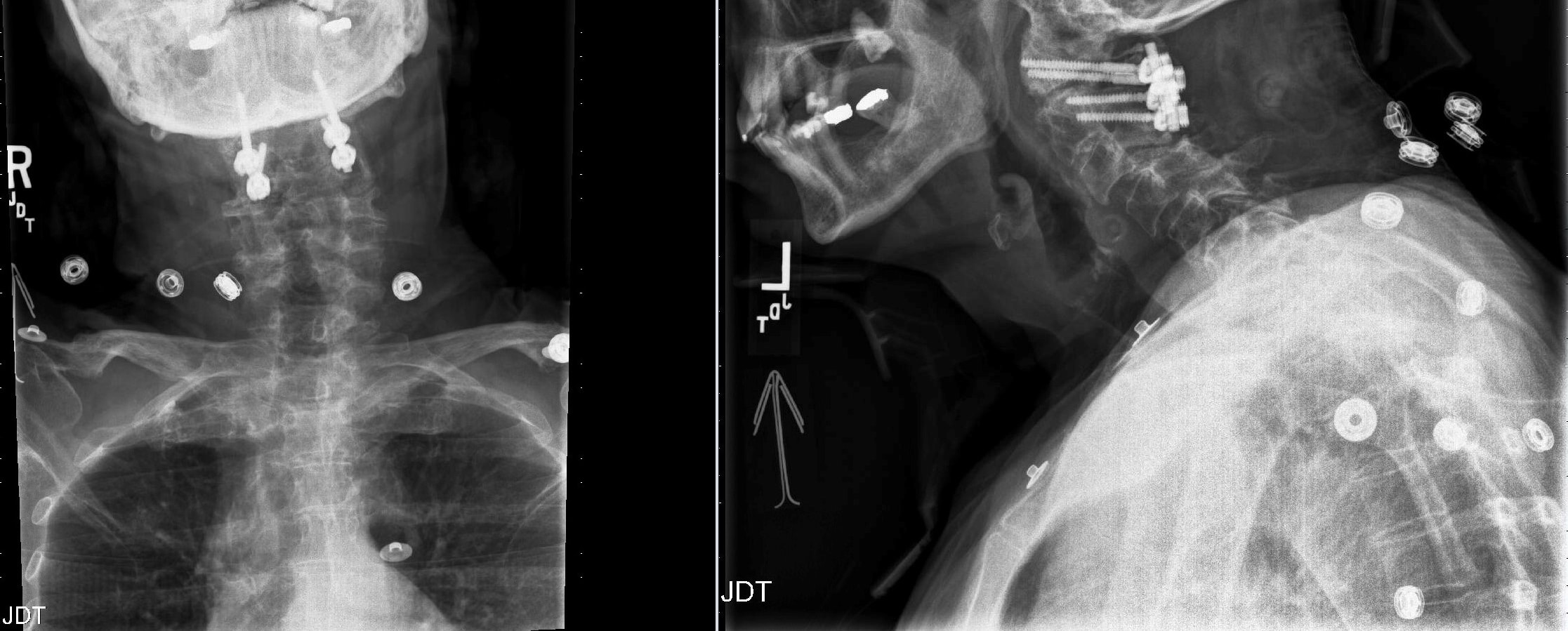 Post-operative X-rays after C1-2 fusion and decompression surgery