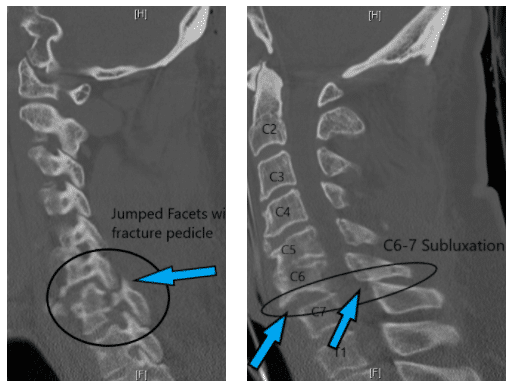 C6 sobre C7 vertibrae