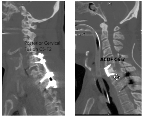 Fusión espinal posterior C5-T2