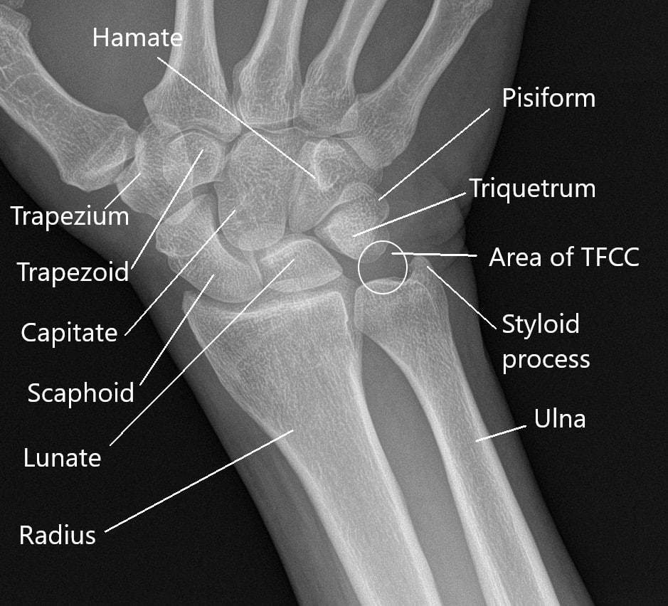 Styloid Process Of Radius Pain