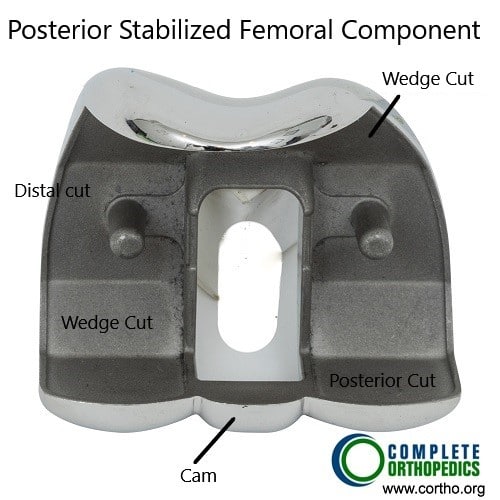 Cemented and Cementless Knee Replacement | Complete Orthopedics