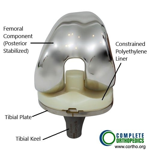 Total knee replacement components (front view)