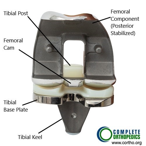 Total knee replacement components (front view)