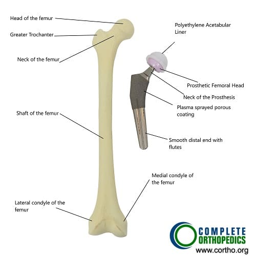 Total Hip Replacement Components