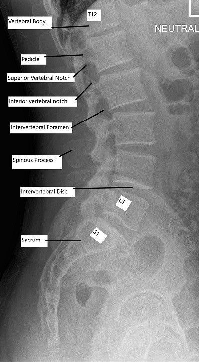 X-ray of the normal Cervical and Lumbar Spine.