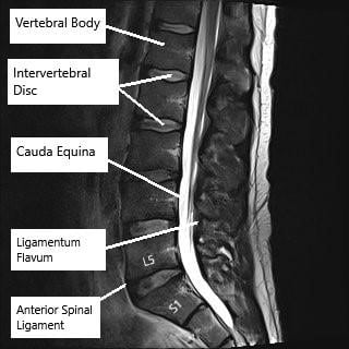 MRI showing the lumbar spine in the axial and sagittal section.