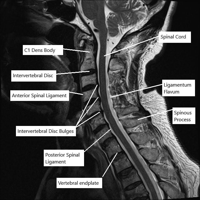 MRI of the cervical spine in sagittal section showing disc herniations