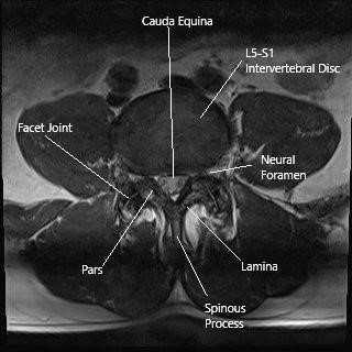 Axial section of the lumbar spine showing the facet joints.