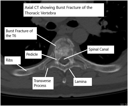 Tomografía computarizada de la columna torácica que muestra una fractura por estallido de la vértebra T6