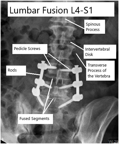 Lumbar Fusion of the L4-L5-S1 vertebrae as seen on an X-ray.
