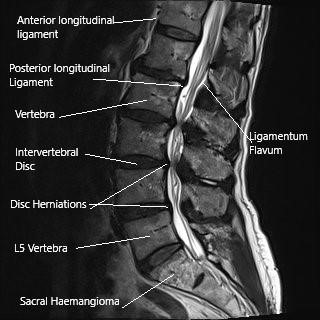 MRI of the lumbar spine in the sagittal section showing disc herniations narrowing the spinal canal.