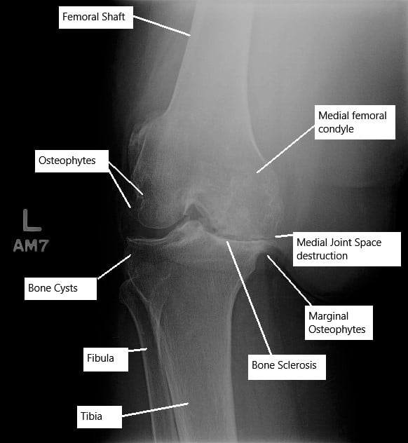 Advance osteoarthritis of the left knee joint on an X-ray.