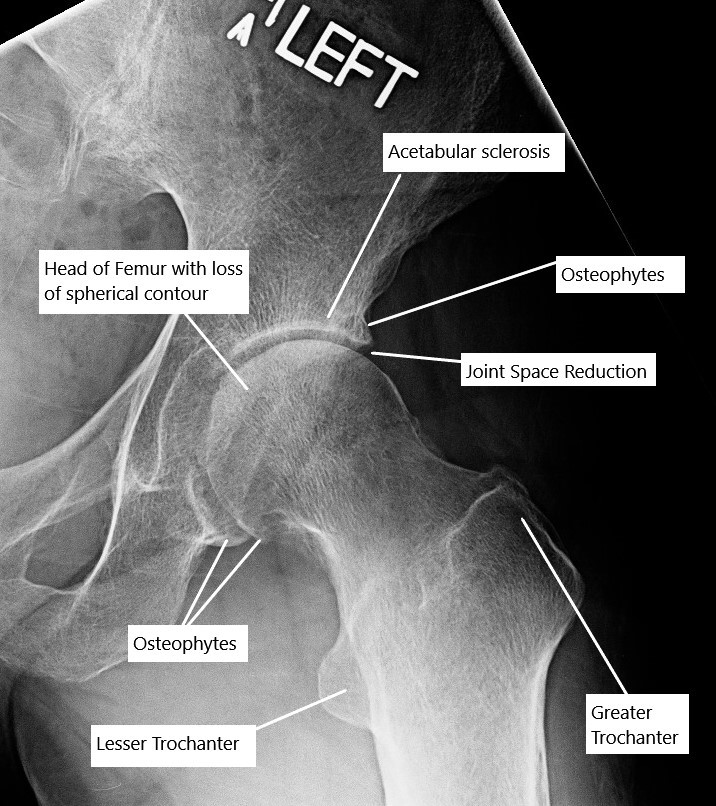 Osteoarthritis of the hip joint on an X-ray.