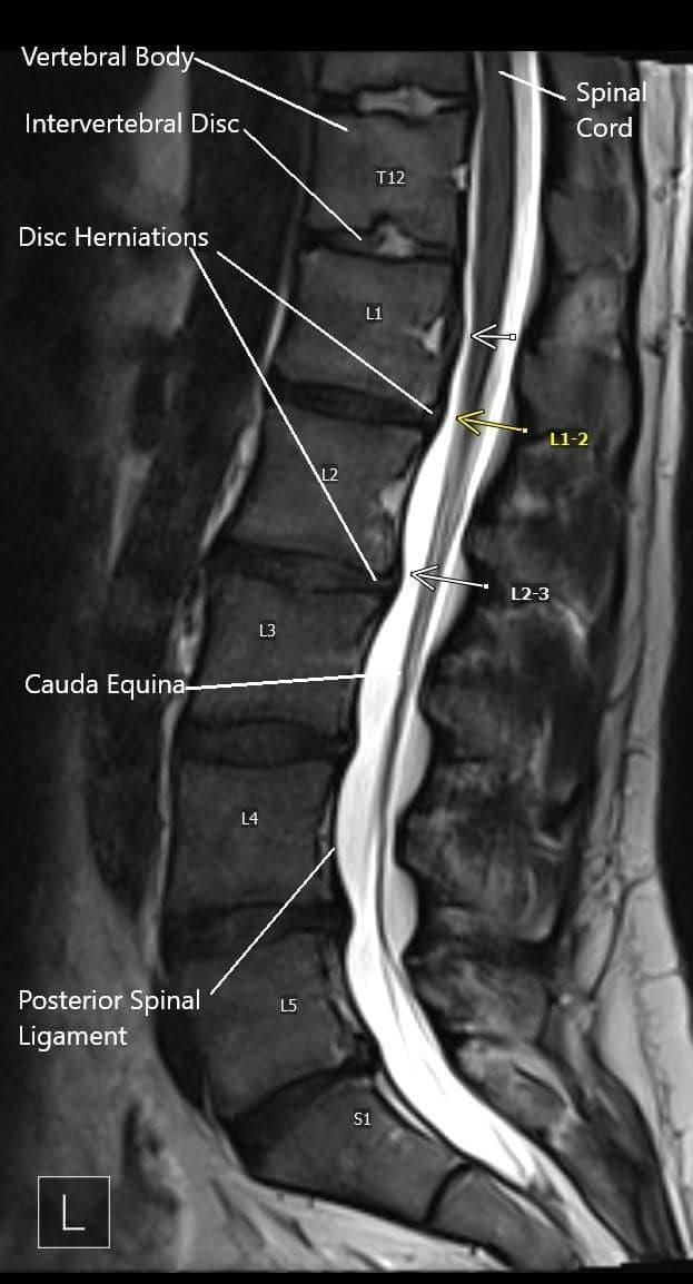 MRI image showing multiple disc herniations.
