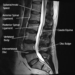 MRI of the lumbar spine in the sagittal section showing disc bulge.