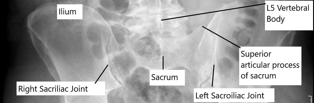 Bilateral sacroiliac joints as seen on X-ray of the pelvis in anteroposterior view.