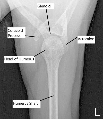Anteroposterior view of Left Shoulder.