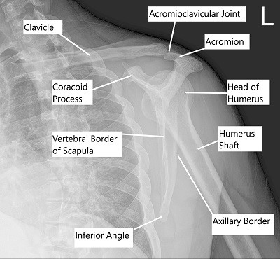 Transscapular view of Left shoulder.
