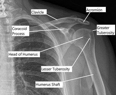 Axial view of left shoulder.