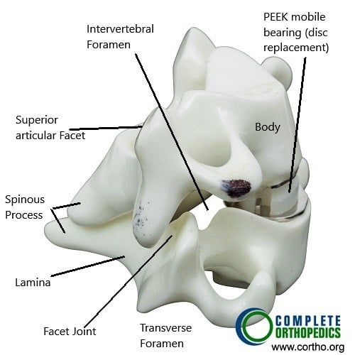 Cervical spine with prosthetic disc