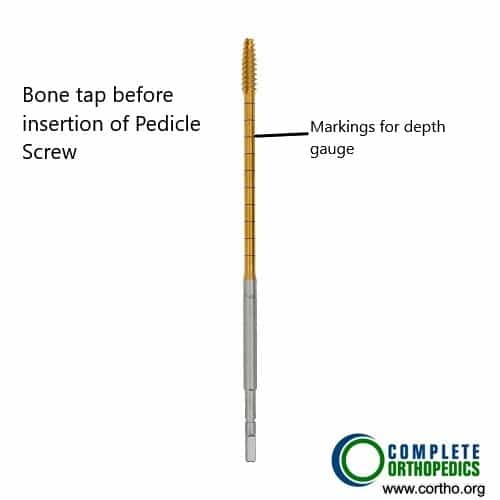Bone tap