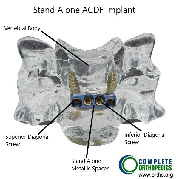 Stand Alone ACDF Implant.