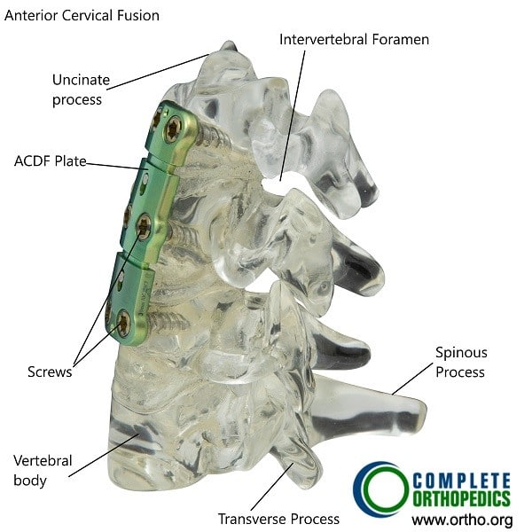 Anterior cervical fusion may be done in severe cases of arthritis and instability of the cervical spine resulting from juvenile idiopathic arthritis